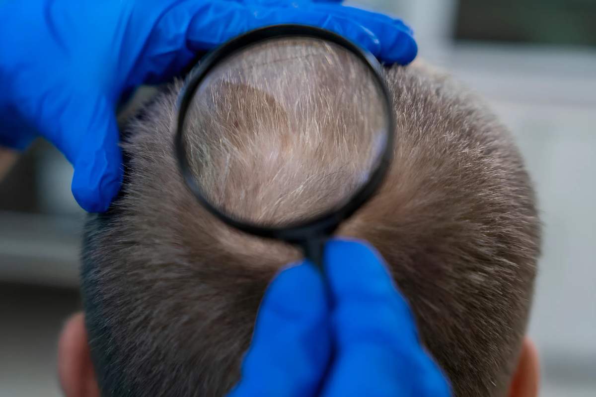 Hair Loss Alopecia: Causes, Types, and Hopeful Solutions